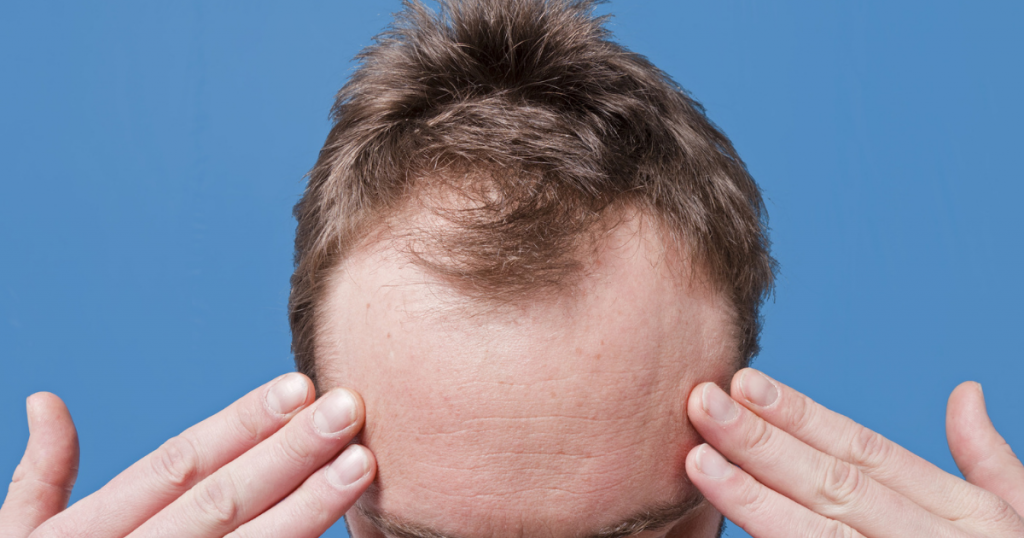 Deal With Male-Pattern Baldness