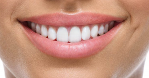 Complete Smile Makeover