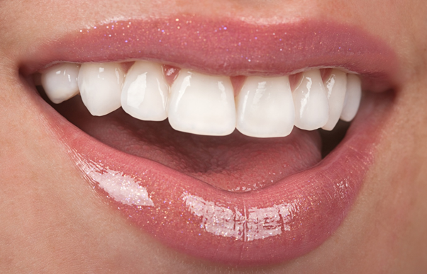 Veneers vs Bonding